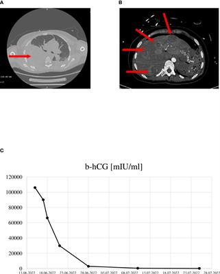 Choriocarcinoma complicated with intra-abdominal and intrapleural hemorrhage in pregnancy – case report